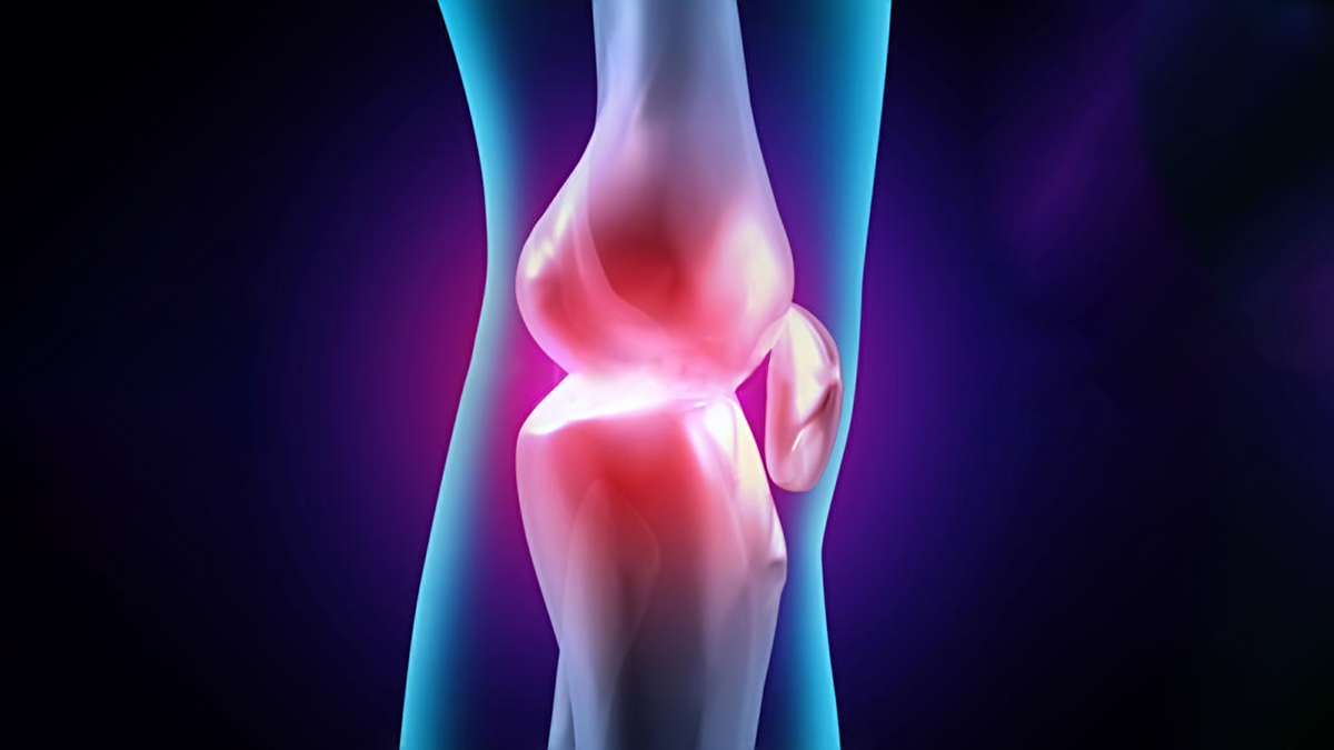 案例|干細胞療法在膝關節炎中的研究進展